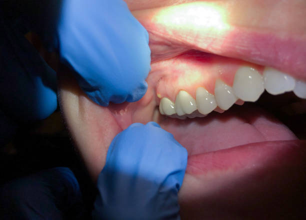 Emergency Dental Filling Replacement in MI